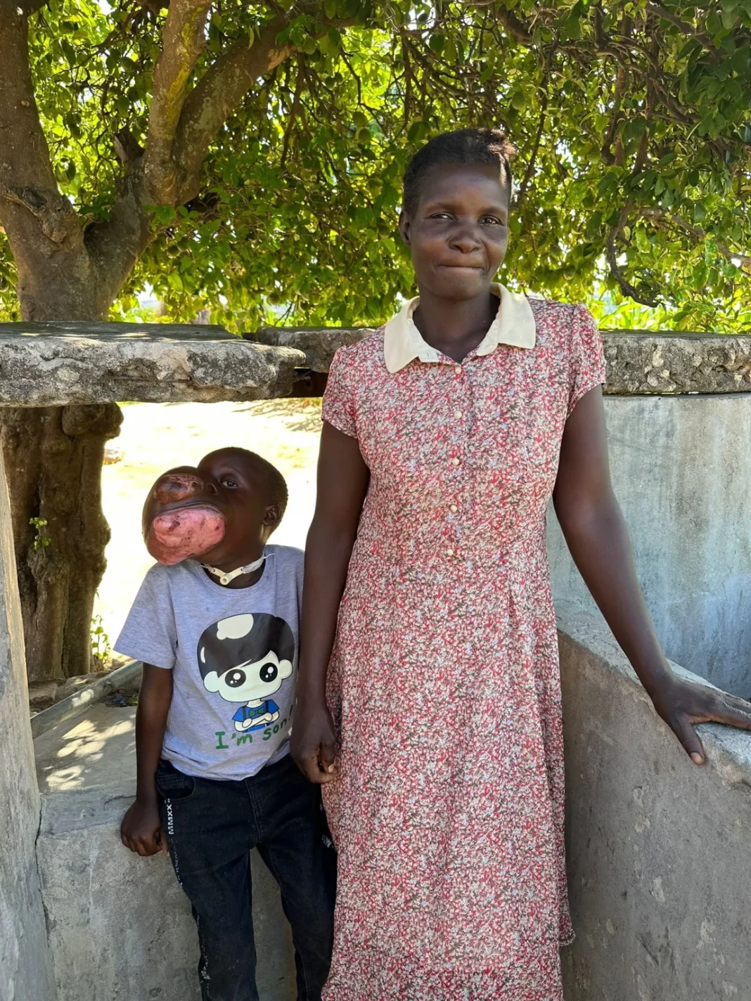 A young boy with a large facial growth stands beside an adult woman outdoors under a tree near a concrete structure.